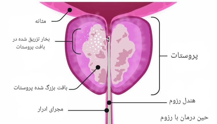 درمان پروستات با بخار رزوم