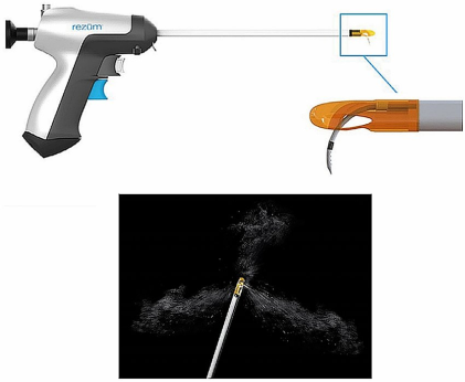 رزوم، ریزوم، سوزن ریزوم، سون ریزوم، دستگاه رزوم، دستگاه بخار آب پروستات، بیماری بزرگی پروستات، هزینه درمان پروستات با رزوم، هزینه درمان پروستات با بخار آب، هزینه درمان جراحی پروستات، دستگاه رزوم برای پروستات، درمان پروستات با آبجوش