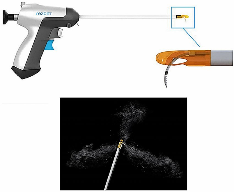  درمان پروستات با بخار آب چگونه است؟
