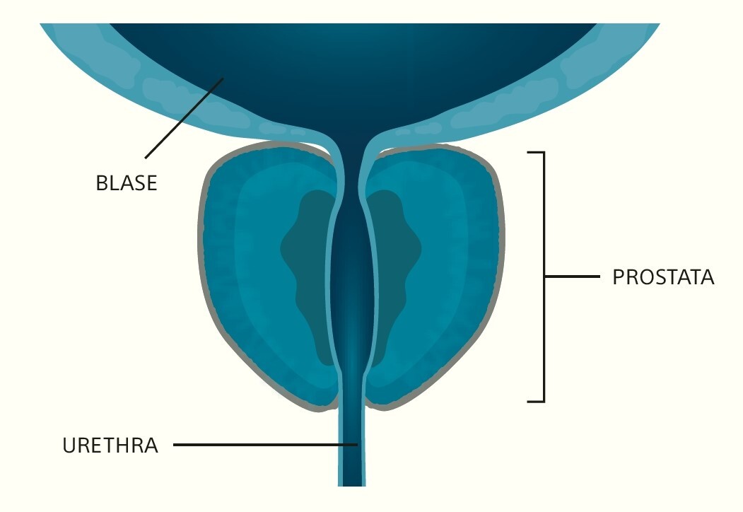 نتایج درمان پروستات با رزوم
