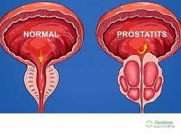 نتایج درمان پروستات با رزوم