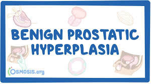 درمان پروستات با آبجوش- هایپرپلازی خوش‌خیم پروستات، پروستات، سرطان پروستات، BPH، درمان پروستات، بیماری پروستات، جدیدترین روش درمانی پروستات، رزوم، پروستات با بخار آب
