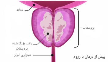 بیماری بزرگی پروستات، BPH، مشکلات جنسی آقایان، تکرر ادرار، جراحی پروستات، درمان پروستات با بخار آب، درمان پروستات با آبجوش، عمل جراحی پروستات