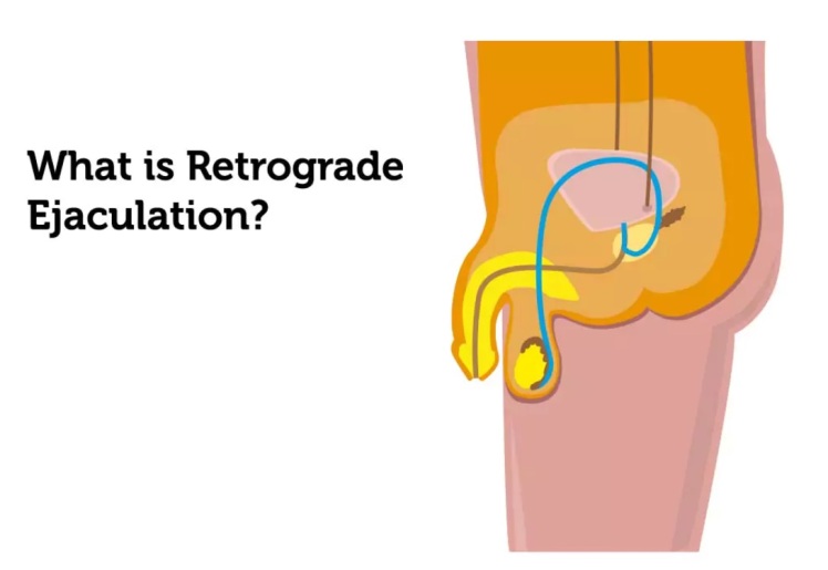 آیا ممکن است رزوم موجب اختلال نعوظ شود؟