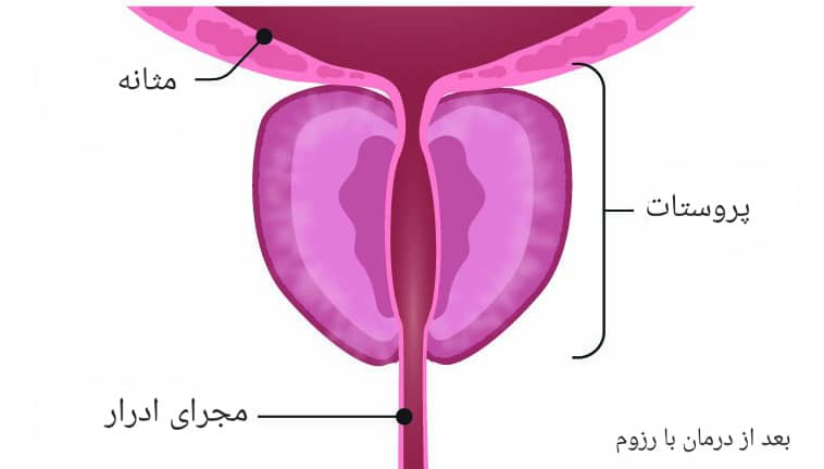 پروستات پس از درمان با رزوم