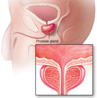  بیماری هایپرپلازی خوش خیم پروستات (BPH)